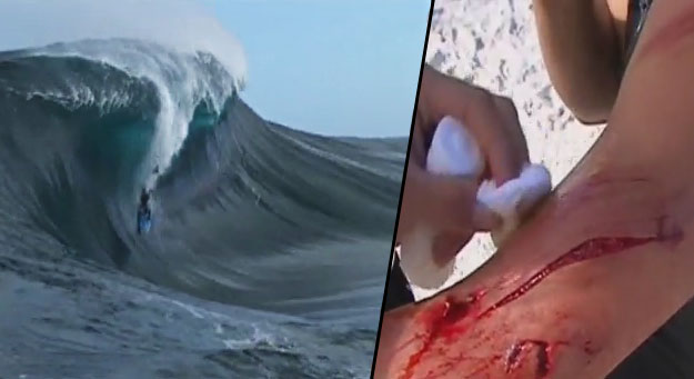 Surfers don't realize that spongers are, and have been, pushing the sport by example—and they’ve been risking their lives to do it. Bodyboarder Huge Wave Cut Injured