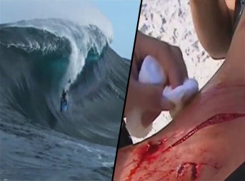 Bodyboarder Huge Wave Cut Injured