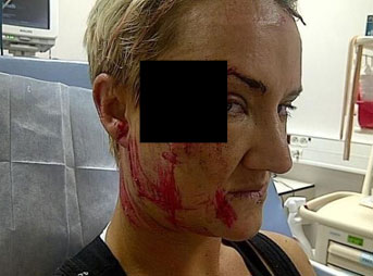 Keala Kennelly accident at Teahupoo