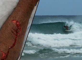 Dan Jorgenson was recently attacked by an elusive Bull Shark in New Smyrna Beach, Florida ("The Shark Attack Capital of the World"). This is his story – in his words.