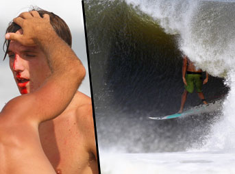 Broken Nose Surfer Blood Barrels Outer Banks