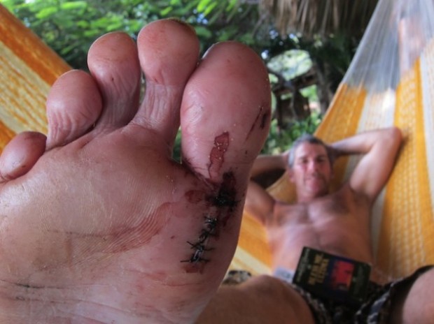 Surf injuries are never welcome nor pretty. Learn how to keep yourself safe to avoid a trip to the medic. Surf injuries are never welcome nor pretty. Learn how to keep yourself safe to avoid a trip to the medic.