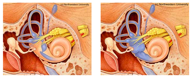 Without (L) and with (R) Meniere's disease. Photo: Northwestern University