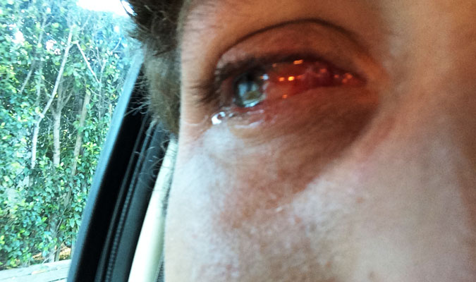 This is just after I left the doctor to remove the eyepatch. The eye wants to stay closed after a day in a patch. It didn't even hurt terribly, but like Tracy Chapman, it wanted darkness. And it wanted tears. 