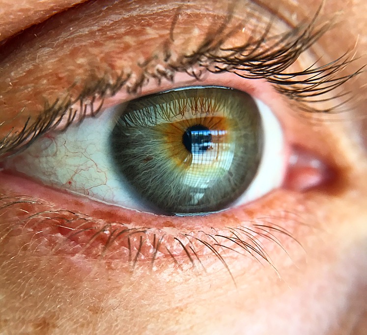 This is the same eyeball today. About six months after surgery. Granted, this is taken with a macro lens, but that grey/blue area around the hazel in my cornea never used to exist. 