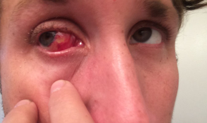 post-pterygium2