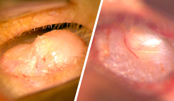 Before (left) and after (right) of the left ear canal. You can now clearly see the ear drum.