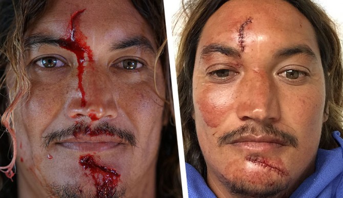 Mikala Jones Injured Stitches to Face at Off the Wall