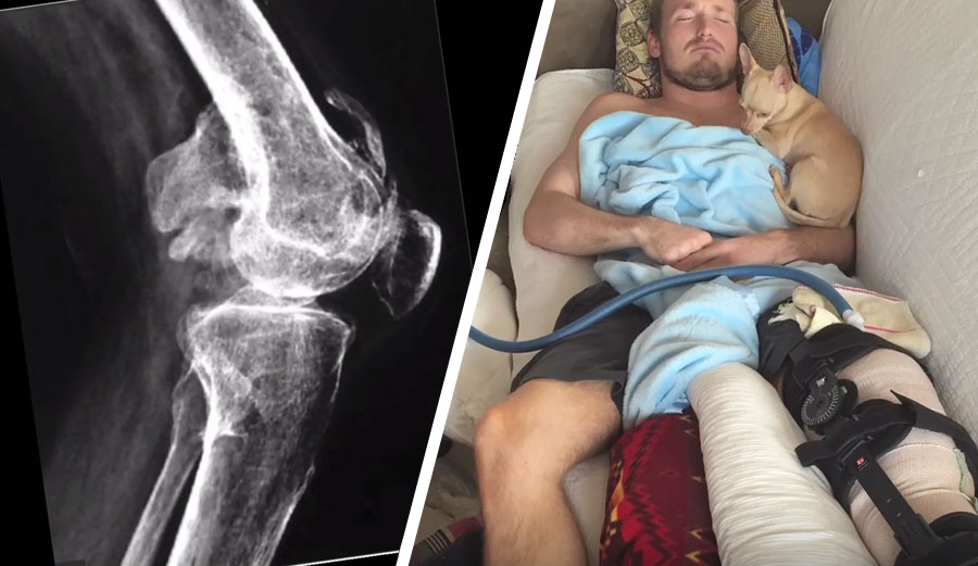 Injury Ben Gravy