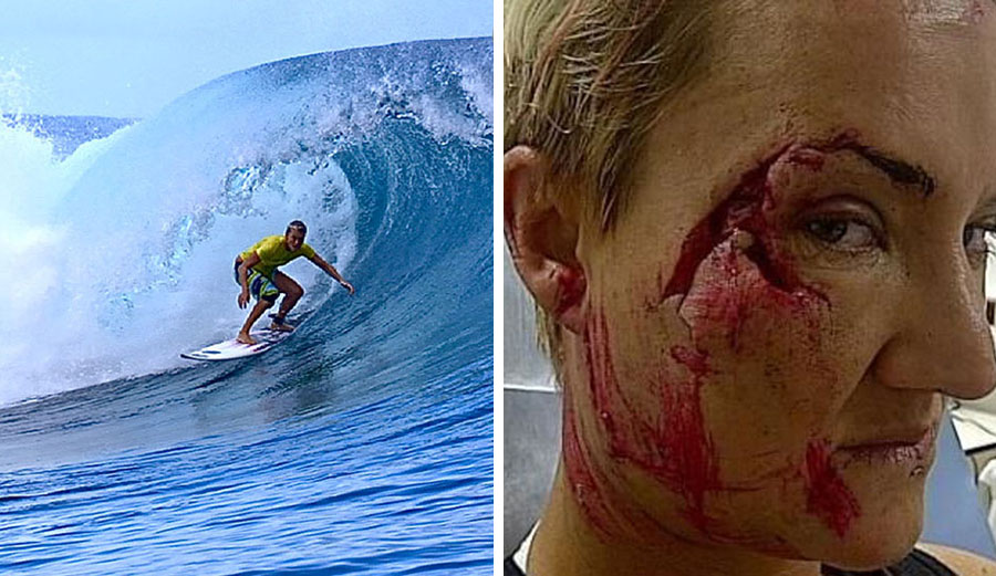 One of surfing's most graphic injuries came from a day at Teahupoo that didn't seem capable of inflicting the kind of damage that it did.