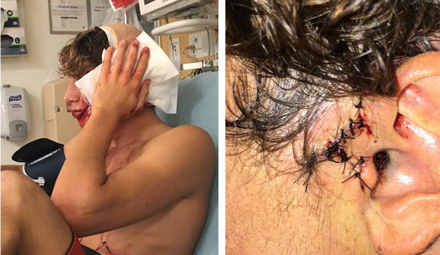 When Leonardo Fioravanti went for a morning surf at Huntington Beach before the Vans US Open of Surfing, he didn't expect to end it in the hospital.