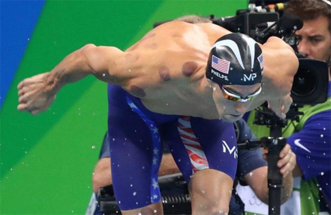 cupping