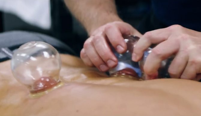 cuppingtherapy_900