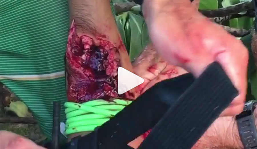 After a tourniquet was tied on, Federico was transported to the hospital with wounds to his leg and forearm. He's expected to make a full recovery. After a tourniquet was tied on, Federico was transported to the hospital with wounds to his leg and forearm. He's expected to make a full recovery.