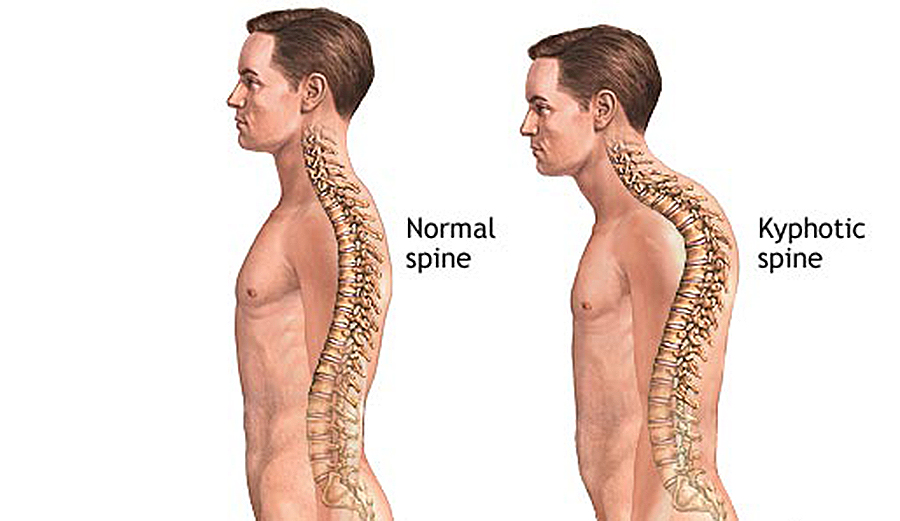 kyphosis