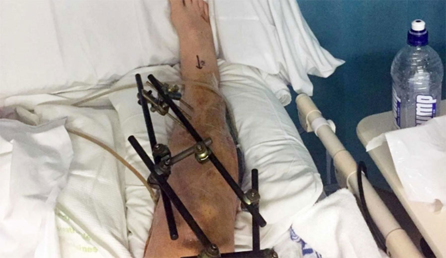 After his wipeout, doctors nearly had to amputate Mathews' leg.