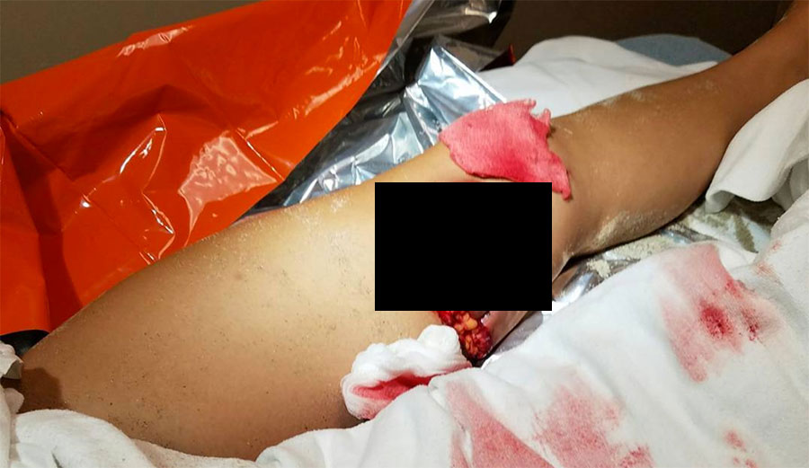 An 18-year-old woman may have been bitten by a shark on Wednesday afternoon in Los Angeles.