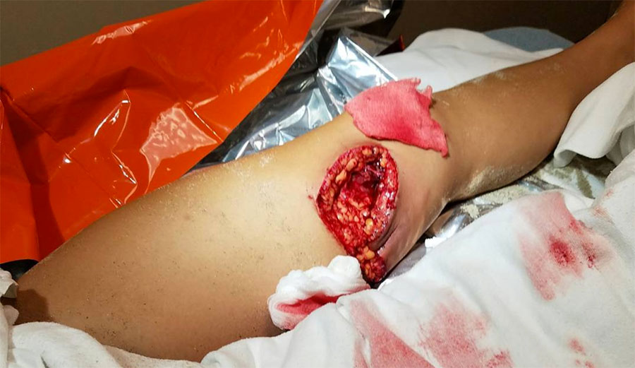 Doctors say the wound is consistent with a shark bite.