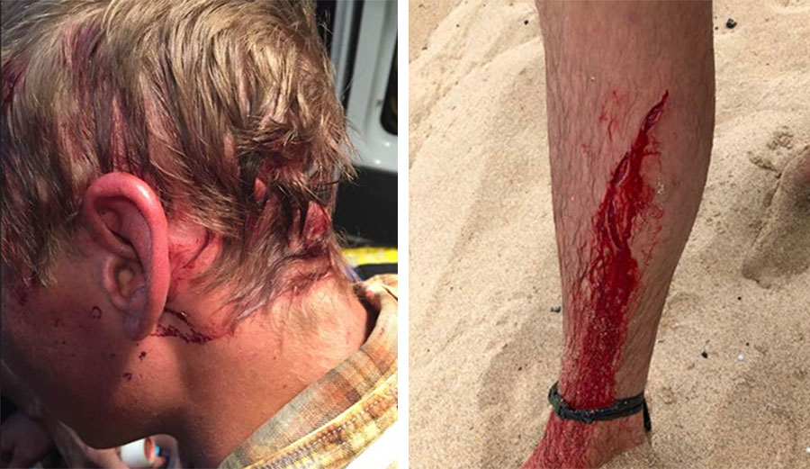 In July of 2017, McWilliams was dragged by his head from his tent by a bear. In April, a shark attacked him in Kauai. Images: McWilliams/Facebook