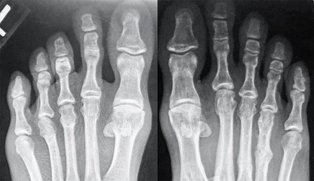Kelly Slater is suffering from turf toe, an injury that affects the ligaments around the big toe. Now he doubts he'll be able to compete at J-Bay.