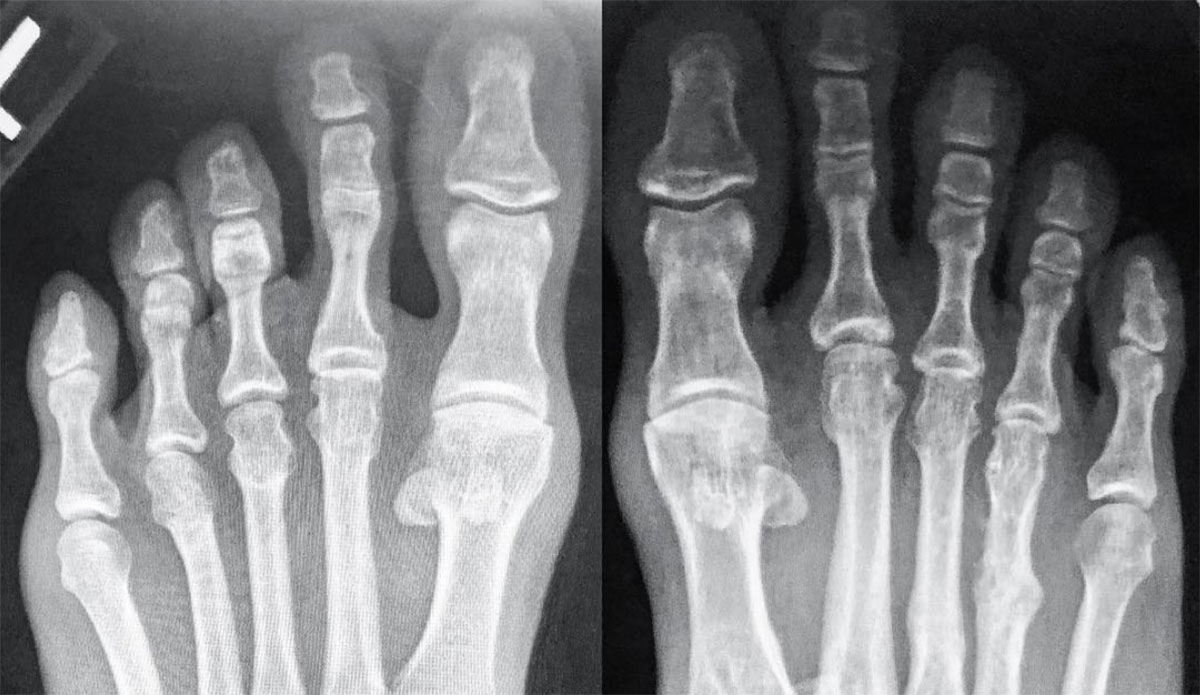 Kelly Slater is suffering from turf toe, an injury that affects the ligaments around the big toe. Now he doubts he'll be able to compete at J-Bay.