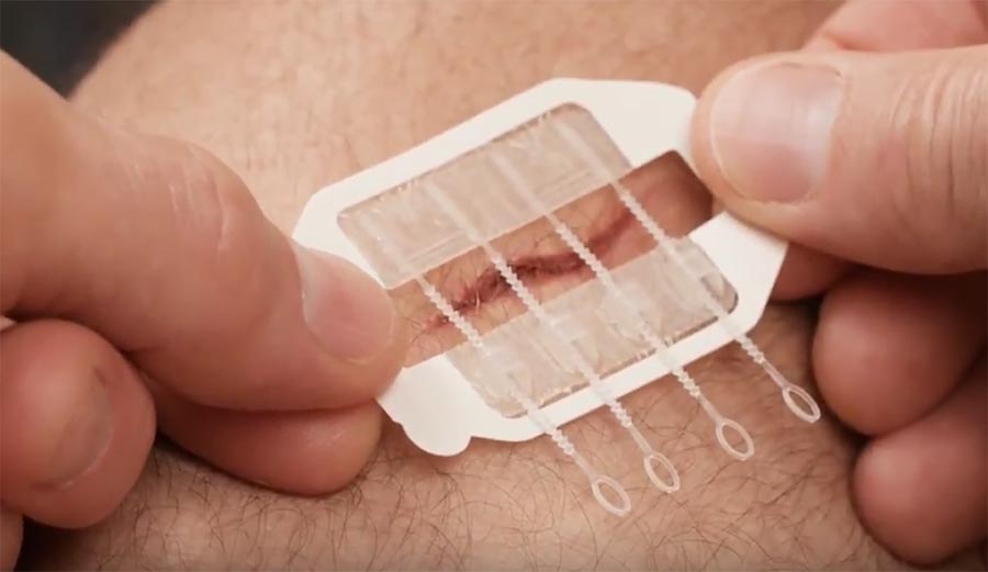 ZipStitch, wounds, stitches, sutures, reddit, flipboard