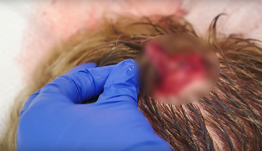Jamie O'Brien head wound from Pipeline