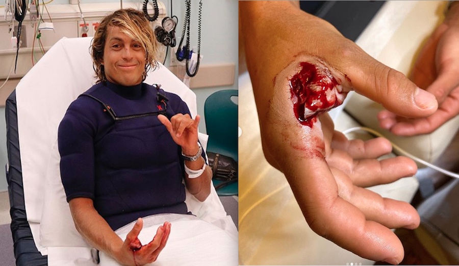 Big Wave Surfer Kai Lenny Mangles Injures Hand Following Accident at Jaws