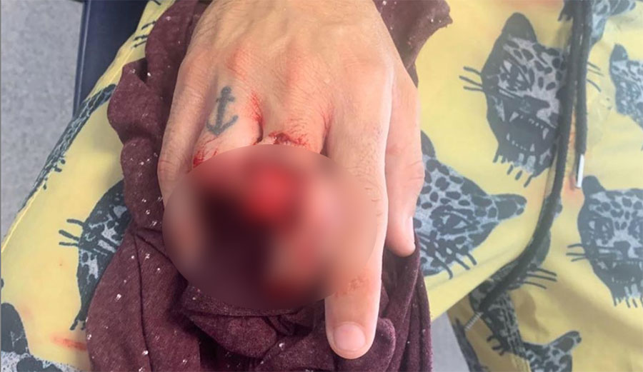William Aliotti surf injury