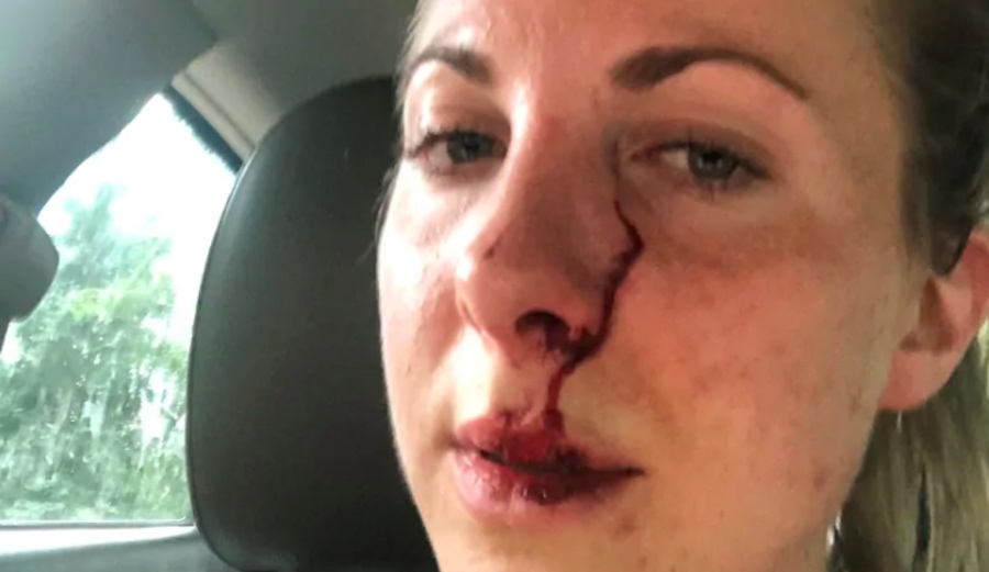 Canadian Runner Recounts Terrifying Story of Being Attacked by Bear
