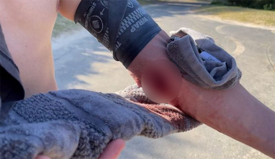 Russell Bierke's forearm cut