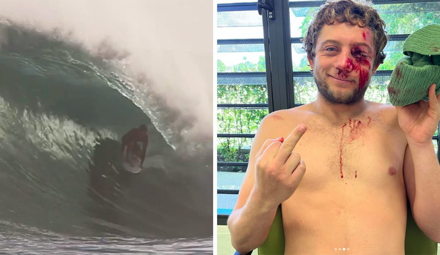 Parker Coffin Suffers Head Injury After Serious Wipeout in Barbados