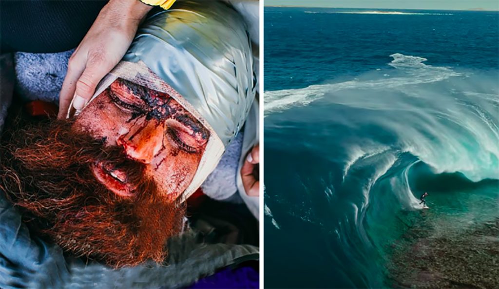 Catching Up With Mutant Slab-Slayer Kerby Brown After His Horrific Surfing Accident