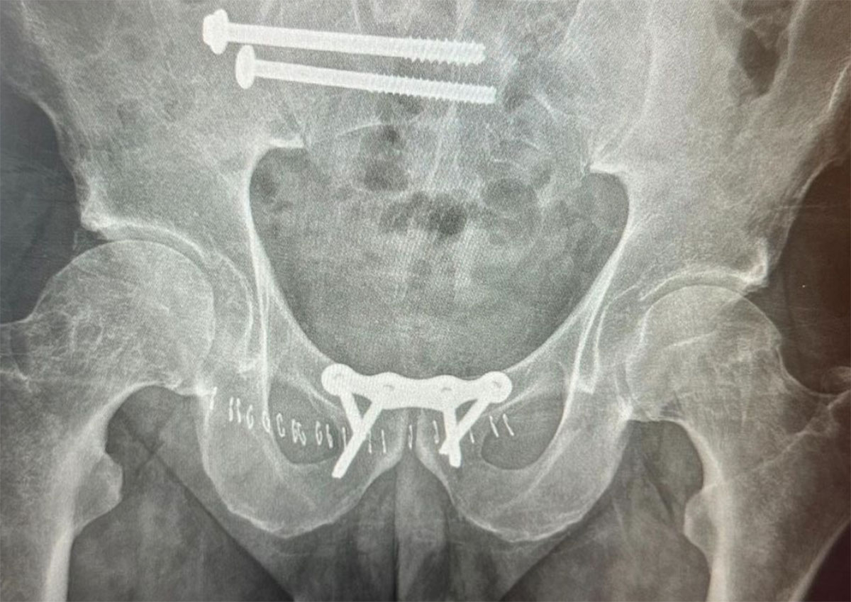 coco Nogales broken pelvis