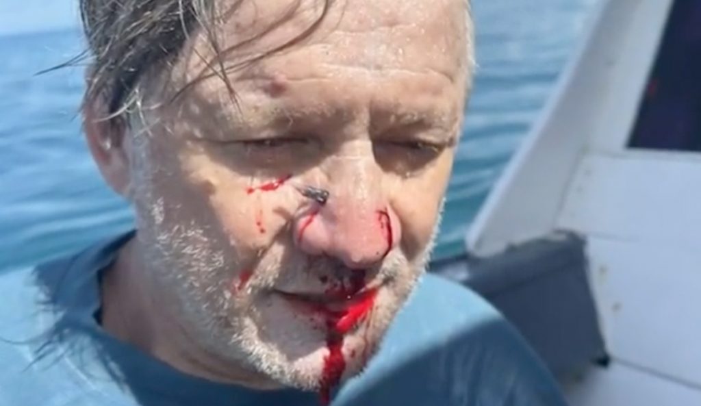 Man is impaled in the face by a garfish in the Mentawais.
