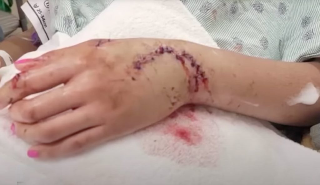 A teen suffered a shark bite while vacationing in Galveston. Photo: Fox 26 Houston // YouTube