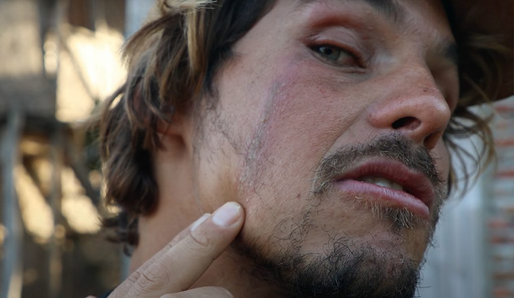 Nic Von Rupp shows off his latest injury at the hands of Indonesian wildlife. Photo: Nic Von Rupp // YouTube