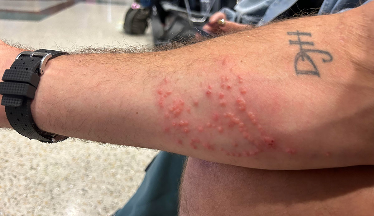 jellyfish stings from Mexico