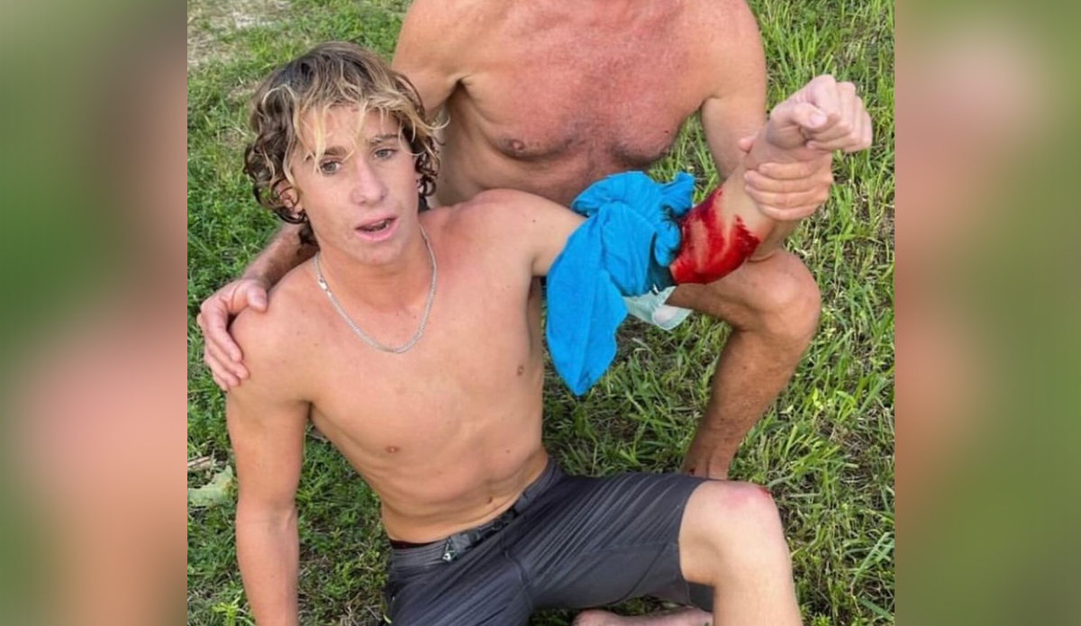 Teddy Wittemann was bitten by a shark while surfing in Brevard County, Florida. Photo: Teddy Wittemann // Instagram