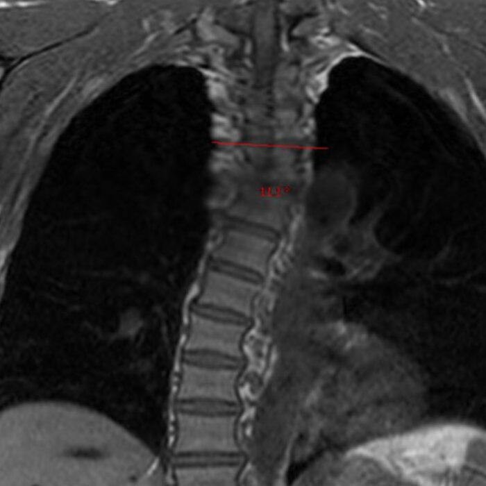 Kelly Slater scoliosis