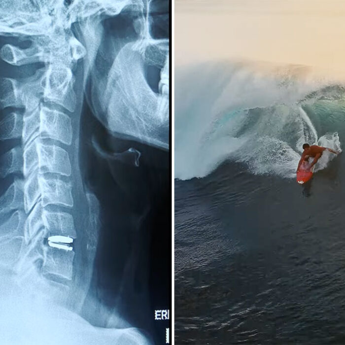 Soli Baily neck x-ray and surfing a wave in Indonesia