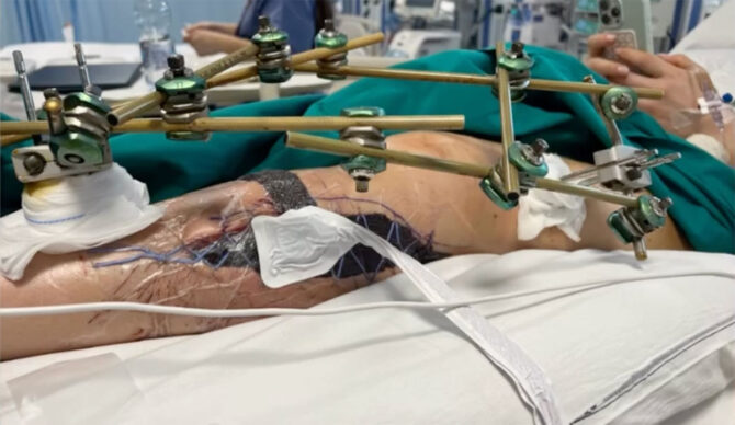 Lindsey Vonn with her leg open after Olympic crash