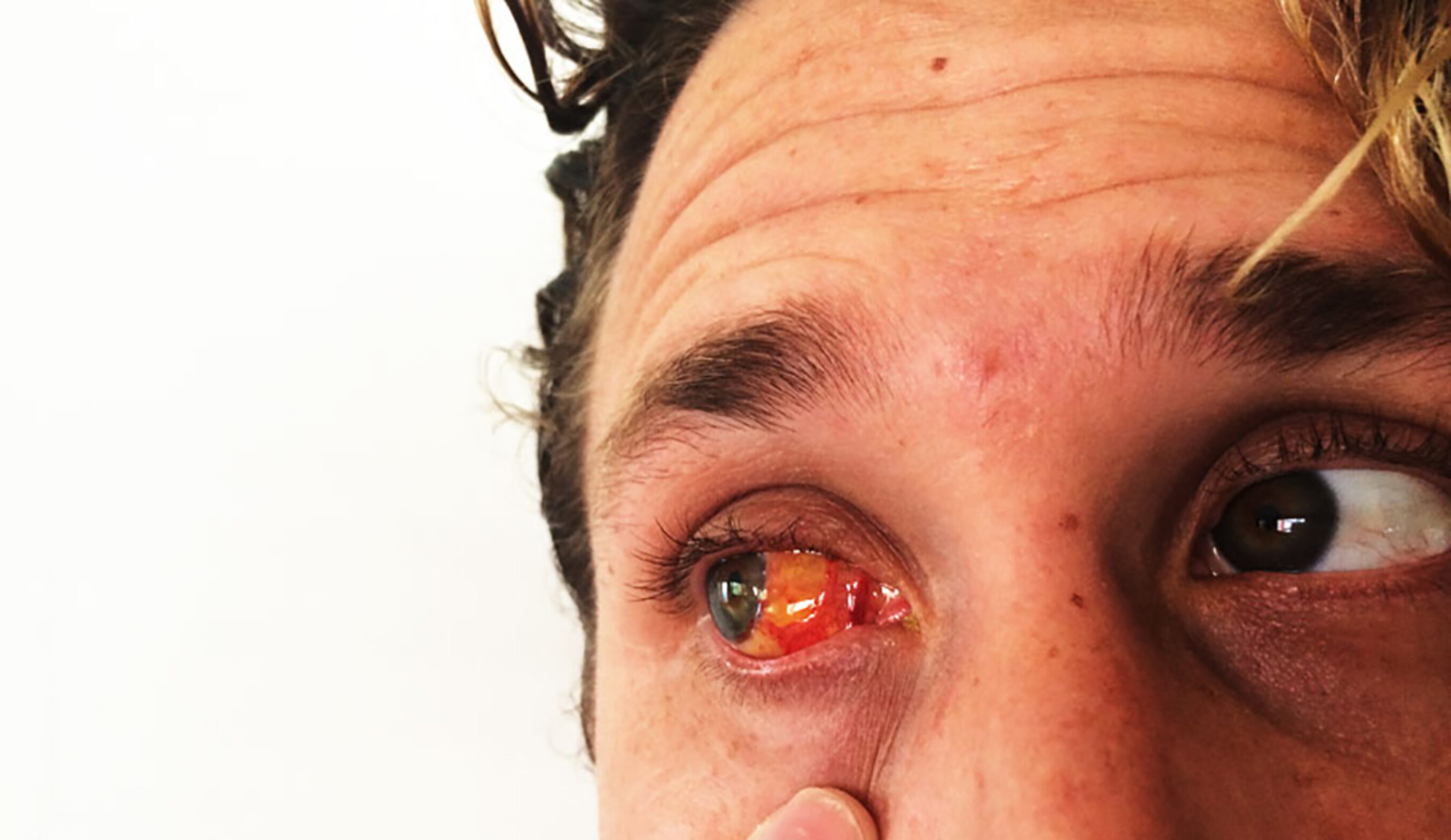 Surfer's Eye Is A Badge Of Honor