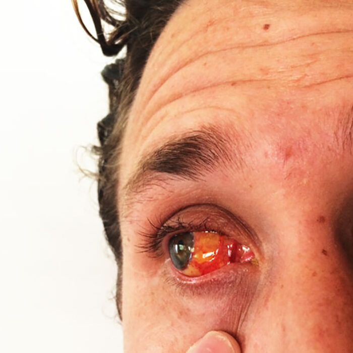Surfer's Eye Is A Badge Of Honor