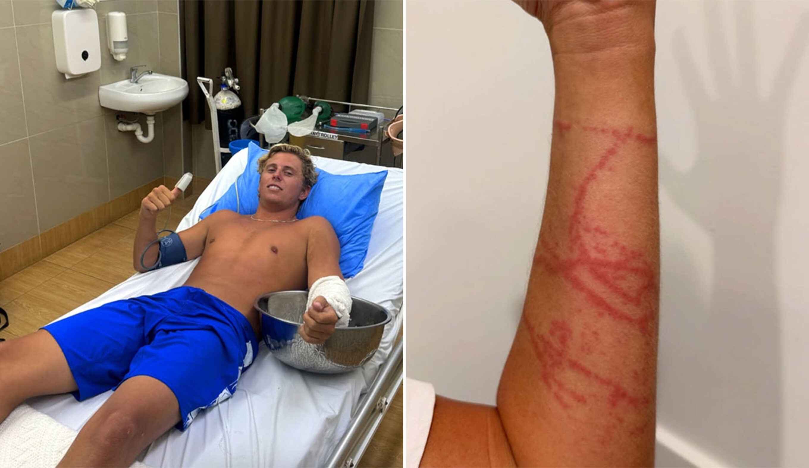 Guy Rowles in hospital after box jellyfish sting