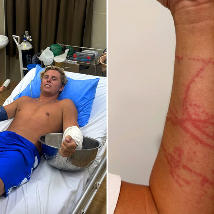 Guy Rowles in hospital after box jellyfish sting